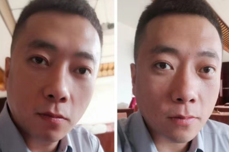 去眼袋手术