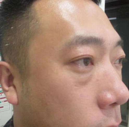 去眼袋手术