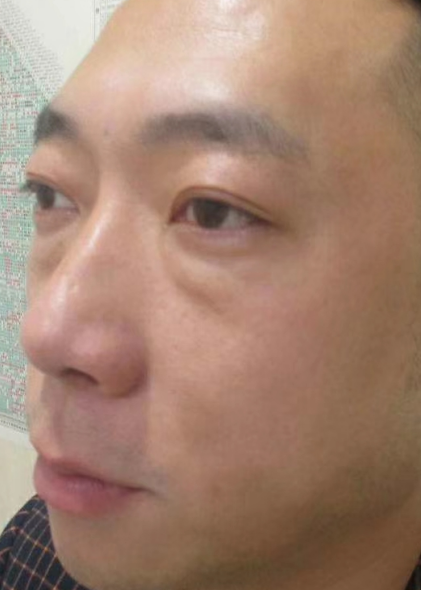 去眼袋手术