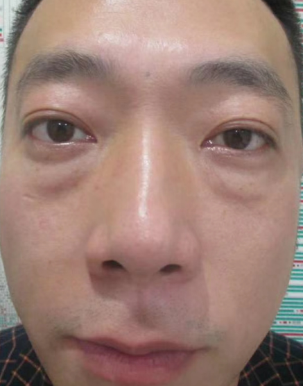 去眼袋手术