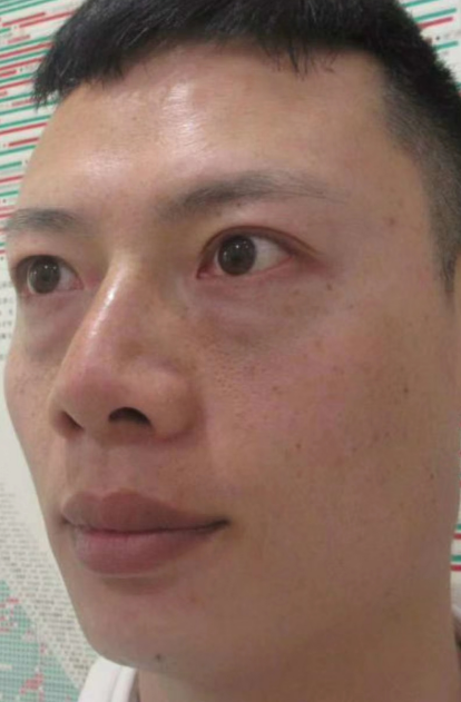 去眼袋手术