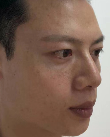 去眼袋手术