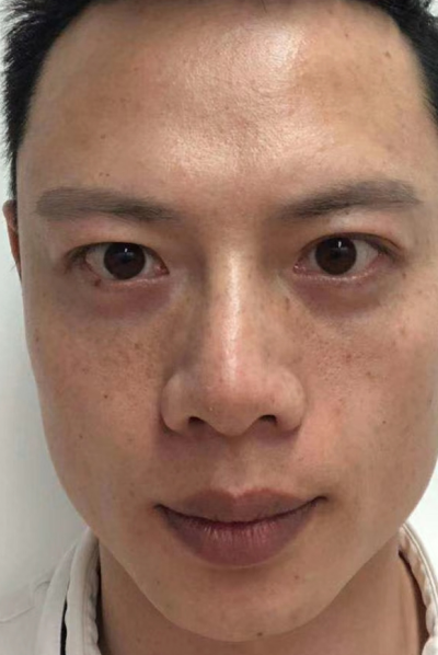去眼袋手术