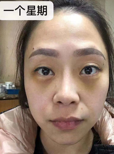 去眼袋手术