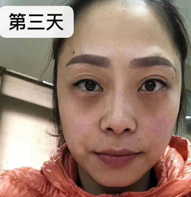 去眼袋手术