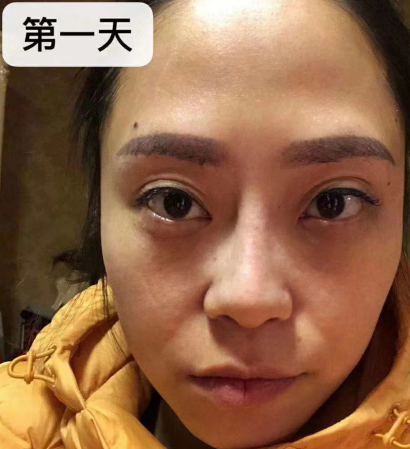 去眼袋手术