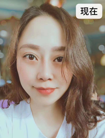 去眼袋手术