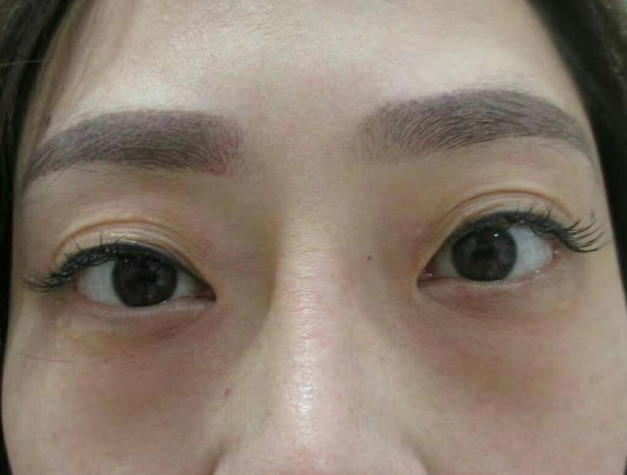 去眼袋手术