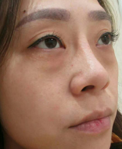 去眼袋手术