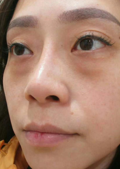 去眼袋手术