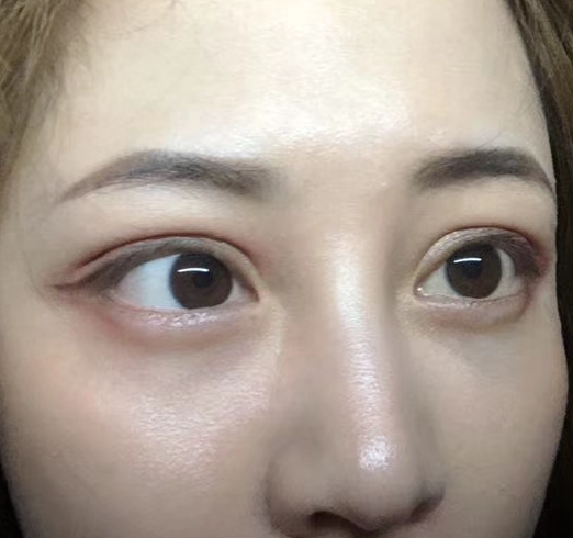 去眼袋手术