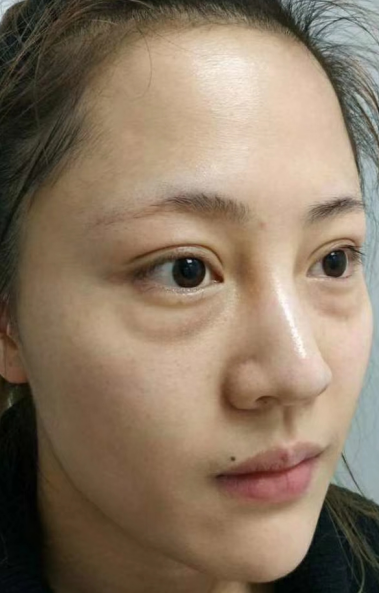去眼袋手术