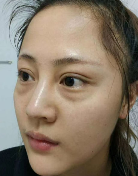 去眼袋手术