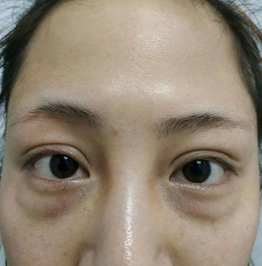 去眼袋手术