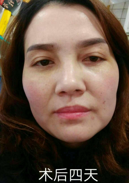 去眼袋手术