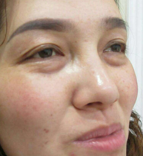 去眼袋手术