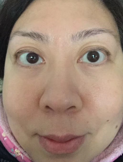 去眼袋手术