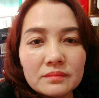 去眼袋手术