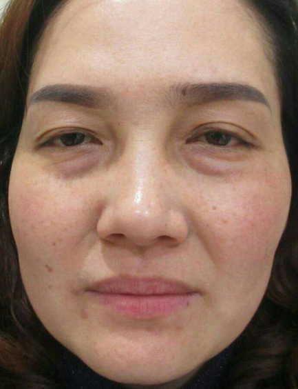 去眼袋手术