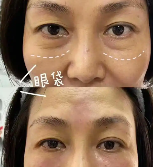 去眼袋手术