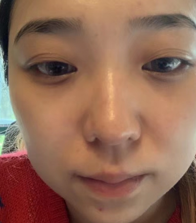 去眼袋手术
