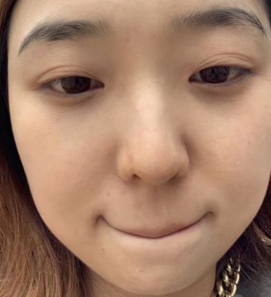 去眼袋手术