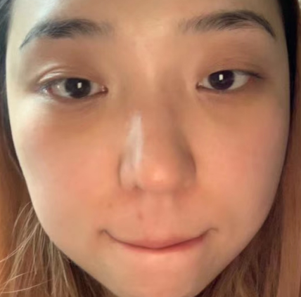 去眼袋手术