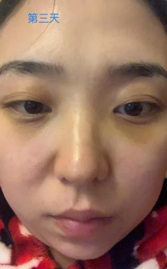 去眼袋手术