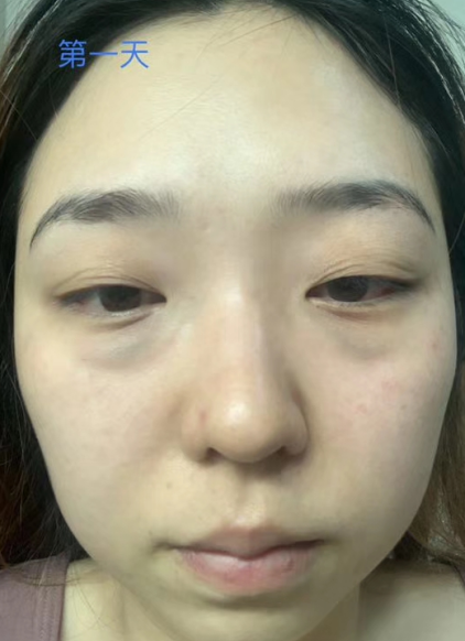 去眼袋手术