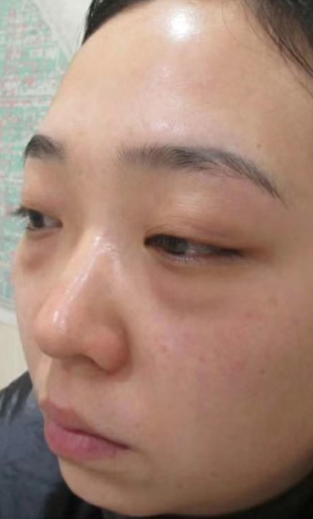 去眼袋手术