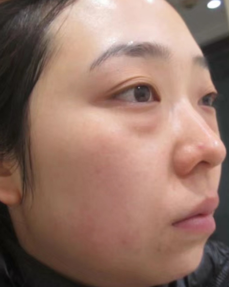 去眼袋手术