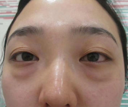 去眼袋手术