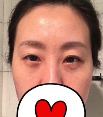 去眼袋手术