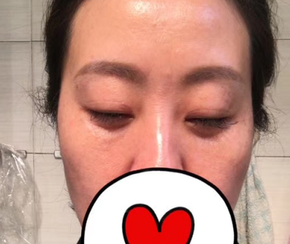去眼袋手术