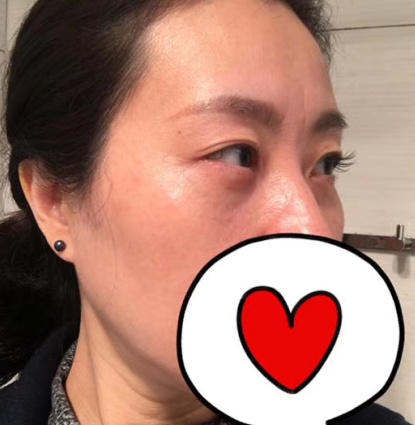 去眼袋手术