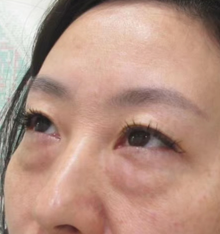 去眼袋手术