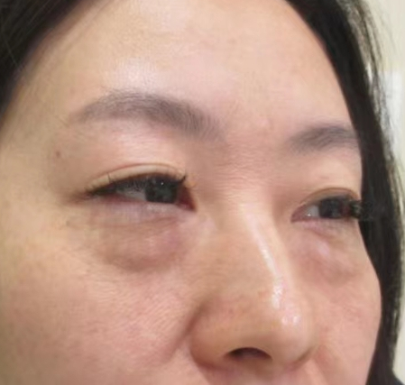 去眼袋手术