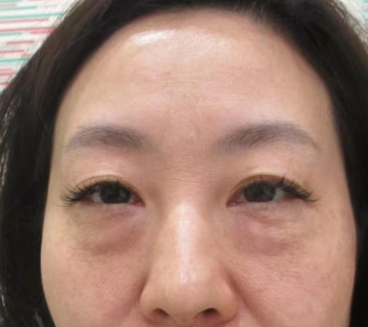 去眼袋手术