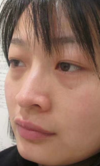 去眼袋手术