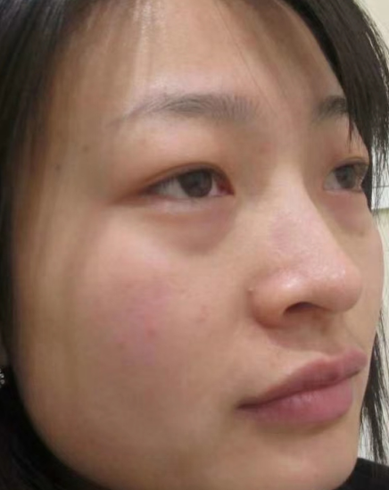 去眼袋手术