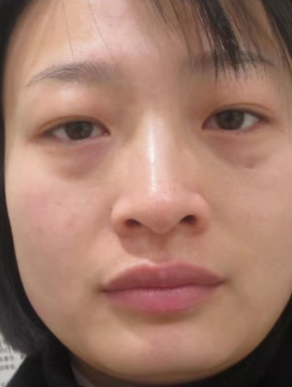 去眼袋手术
