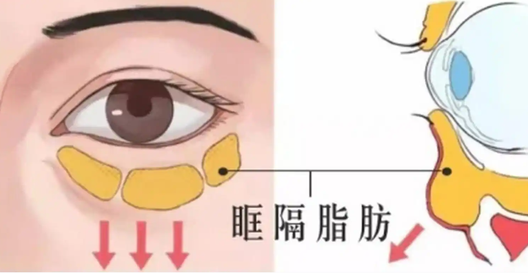 去眼袋手术