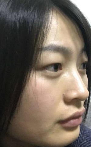 去眼袋手术