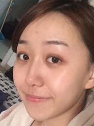 去眼袋手术