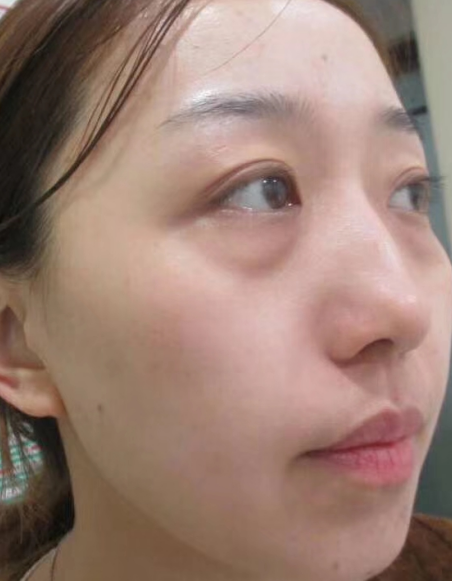 去眼袋手术