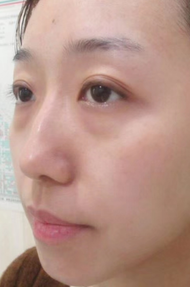 去眼袋手术