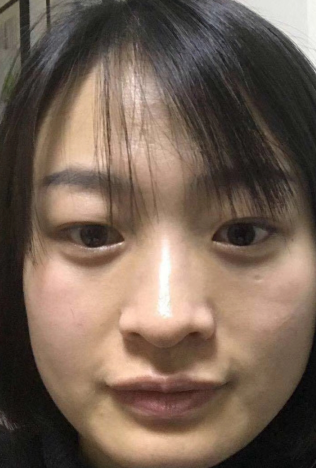去眼袋手术