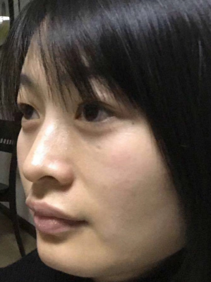 去眼袋手术