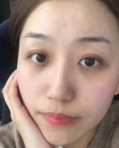 去眼袋手术