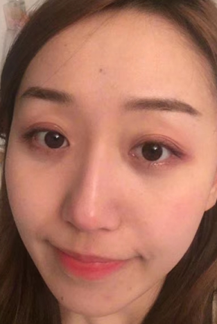 去眼袋手术